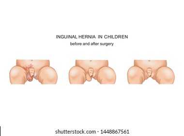 vector illustration of inguinal hernia in a child