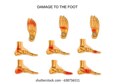 Vector Illustration Injuries Foot Stock Vector (Royalty Free) 638736511 ...