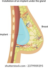 Vector illustration of installation of an implant under the mammary gland.