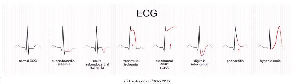 Vector Illustration Of The Interpretation Of ECG. Myocardial Ischemia. Infarction

