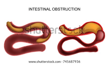 vector illustration of intestinal obstruction due to a cancerous tumor