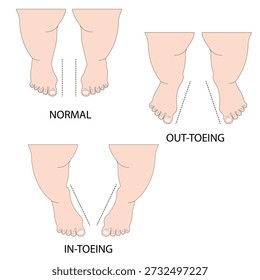 Vector illustration of intoeing (pigeon toe) showing inward-turned feet, gait imbalance, tripping, and related conditions such as metatarsus adductus and tibial torsion baby leg