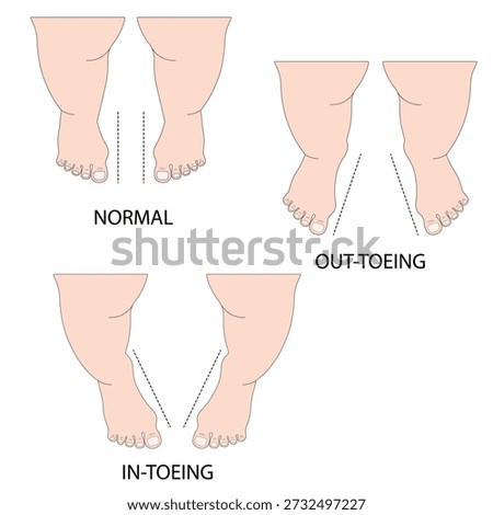 Vector illustration of intoeing (pigeon toe) showing inward-turned feet, gait imbalance, tripping, and related conditions such as metatarsus adductus and tibial torsion baby leg