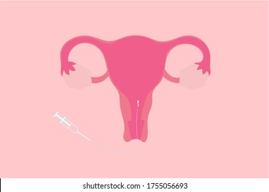 Ilustración vectorial de la inseminación intrauterina (IUI)