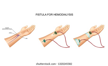 vector illustration of intravenous catheter, hemodialysis and fistula