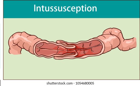 vector illustration of intussusception of intestine. obstruction.