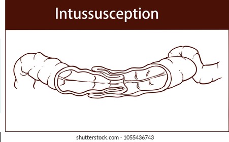 Vektorgrafik der Intussusception des Darms. Obstruktion.