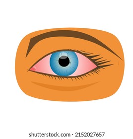 Vector illustration of irritated human eye with redness and blood vessels