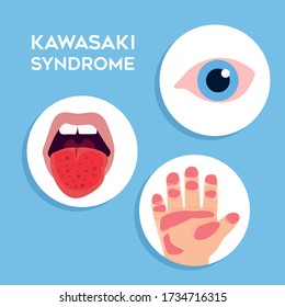 Vector Illustration Of Kawasaki Disease Symptoms