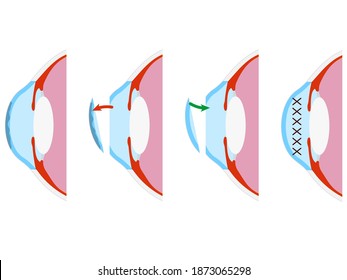 Vector illustration: keratoplasty. Corneal surgery. Eye surgery.