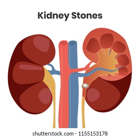 741 Nephropathy Images, Stock Photos & Vectors | Shutterstock