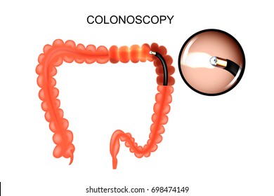 vector illustration of large intestine, colonoscop. medicine