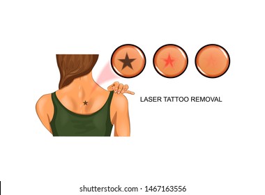 ilustración vectorial de la eliminación del tatuaje láser de la piel