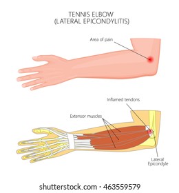 Vector illustration of Lateral Epicondylitis or tennis elbow.  Used: Gradient, transparency, blend mode.