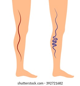 Vector illustration leg veins. The concept of varicose disease. Silhouette of legs on an isolated white background. Drawing varices, picture varicosity.