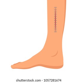 Vector Illustration Leg Wound With Stitches