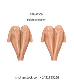 vector illustration of legs before and after hair removal