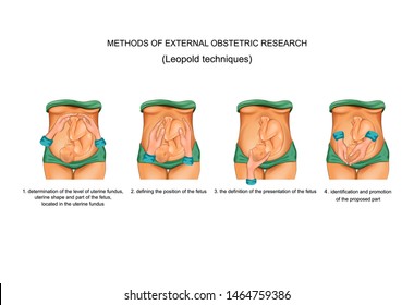 vector illustration of Leopold techniques in obstetrics