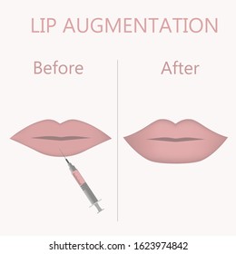 Vector illustration of  lip augmentation with syringe in flat style . Before and after.Lips injection 
isolated over white background.  