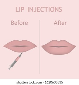 Vector illustration of lip injection with 
syringe ,before and after on pink background. Lip Augmentation in flat style