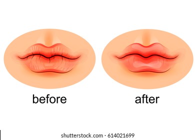 Vector Illustration Of Lips Dry And After Moistening
