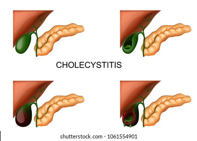 vector illustration of a liver, gall bladder and pancreas. cholecystitis
