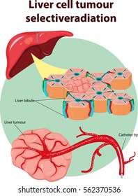 Vector Illustration Of  Liver Tumor Selective Anatomy