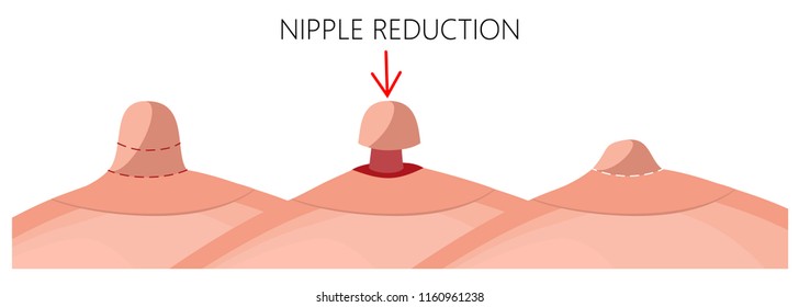 Vector illustration of the long nipple reduction before and after plastic surgery. Side view (close up) of the woman breast. For advertising and medical publications. EPS 10.