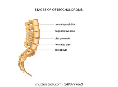 Vector Illustration Of Lumbar Sacral Spine And The Stages Of Degenerative Disc Disease