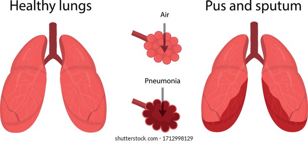 Vector illustration of lung disease. Pneumonia.