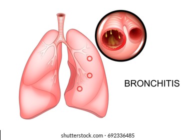 vector illustration of lungs affected by bronchitis
