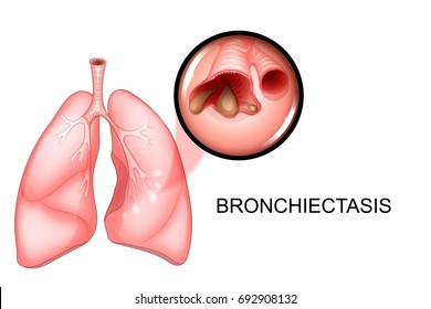 vector illustration of lungs affected by bronchiectasis disease