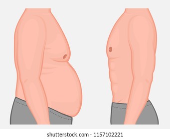 Vector illustration a male before and after weight loss and sports. Side view. For medical publications and advertising of cosmetic, plastic procedures, stomach shunting, diet, sport. EPS 10