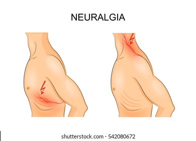 vector illustration of a male torso for medical publications
