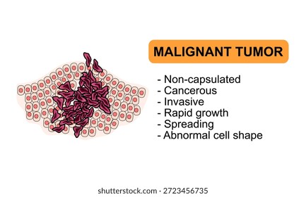 Ilustração vetorial de um tumor maligno. Características de tumores malignos, células cancerosas, invasivas. Ilustração para diagrama médico, elemento de design, cartaz ou treinamento.