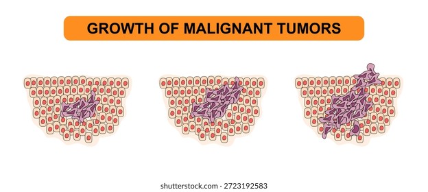 Ilustración vectorial del crecimiento de tumores malignos. El desarrollo de células cancerosas, tumores, diseminación. Ilustración de diagrama médico para póster, educación, ciencia y Elementos de salud.