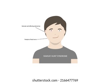 Vector illustration of man with ramsay hunt syndrome. A disorder characterized by paralysis of facial nerve and vesicular rash affecting ear or mouth.