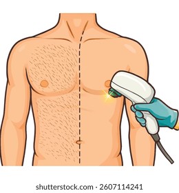 Vector illustration of a man's chest undergoing laser hair removal. Isolated clean and aesthetic artwork on white background. Before and after.