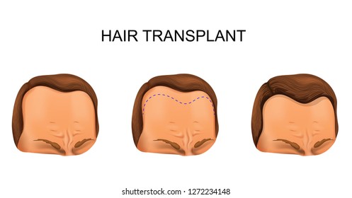vector illustration of a man's hair transplant