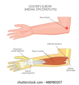 Vector illustration of Medial Epicondylitis or golfer's elbow. Used: transparency, blend mode, gradient.