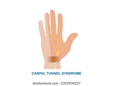 Vector illustration median nerve entrapment at the wrist or carpal tunnel syndrome. 