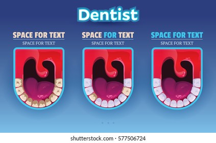 Vector illustration. Medical Poster. Dentist. Healthy Clean Teeth. Providing Dental Care Process.Teeth with Caries. Dental Treatment.ENT. The Treatment Process.Screaming mouth.