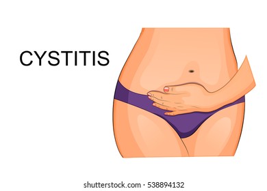 vector illustration for medical publications. inflammation of the pelvic organs
