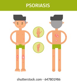 medicine symptomatology skin diseases psoriasis flat character