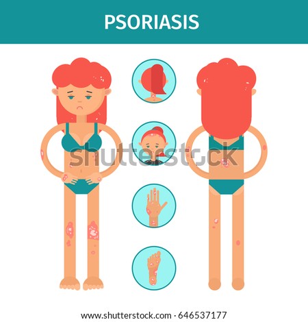 medicine symptomatology skin diseases psoriasis flat character