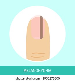 Vector illustration "Melanonychia". Circle icon of fingernail with brown line. Colorful image for medical articles, posters and banners.