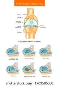 Vector Illustration Meniscus Anatomy 6 Types Stock Vector (Royalty Free ...