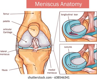  vector illustration of a Meniscus tear and surgery