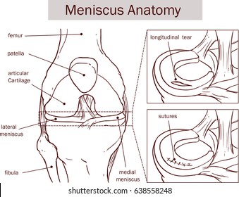  vector illustration of a Meniscus tear and surgery