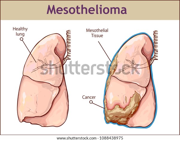 malignant mesothelioma epithelial